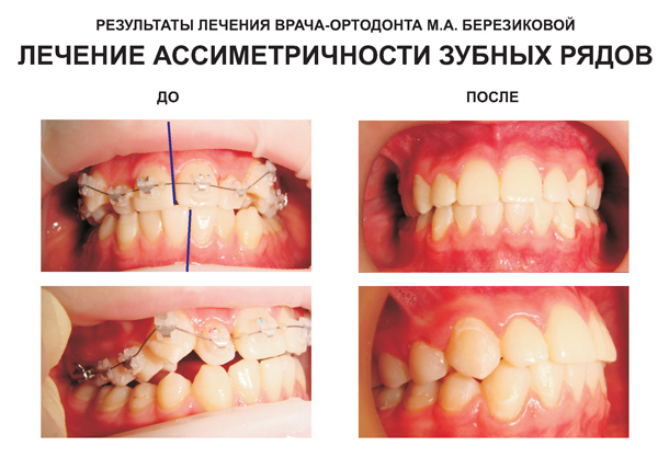 лечение ассиметричности зубов