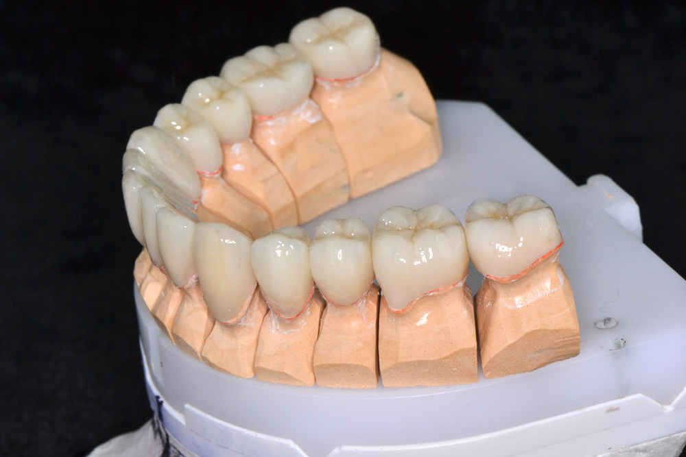 керамический зуб